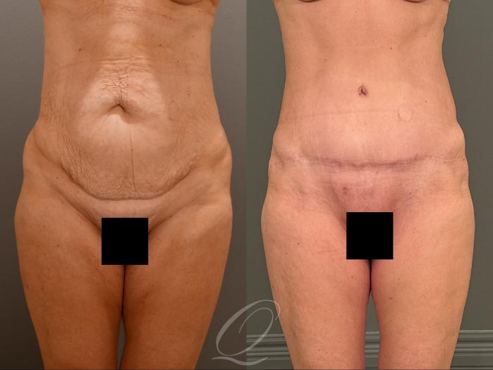 Tummy Tuck Case 1001908 Before & After Front | Serving Rochester, Syracuse & Buffalo, NY | Quatela Center for Plastic Surgery