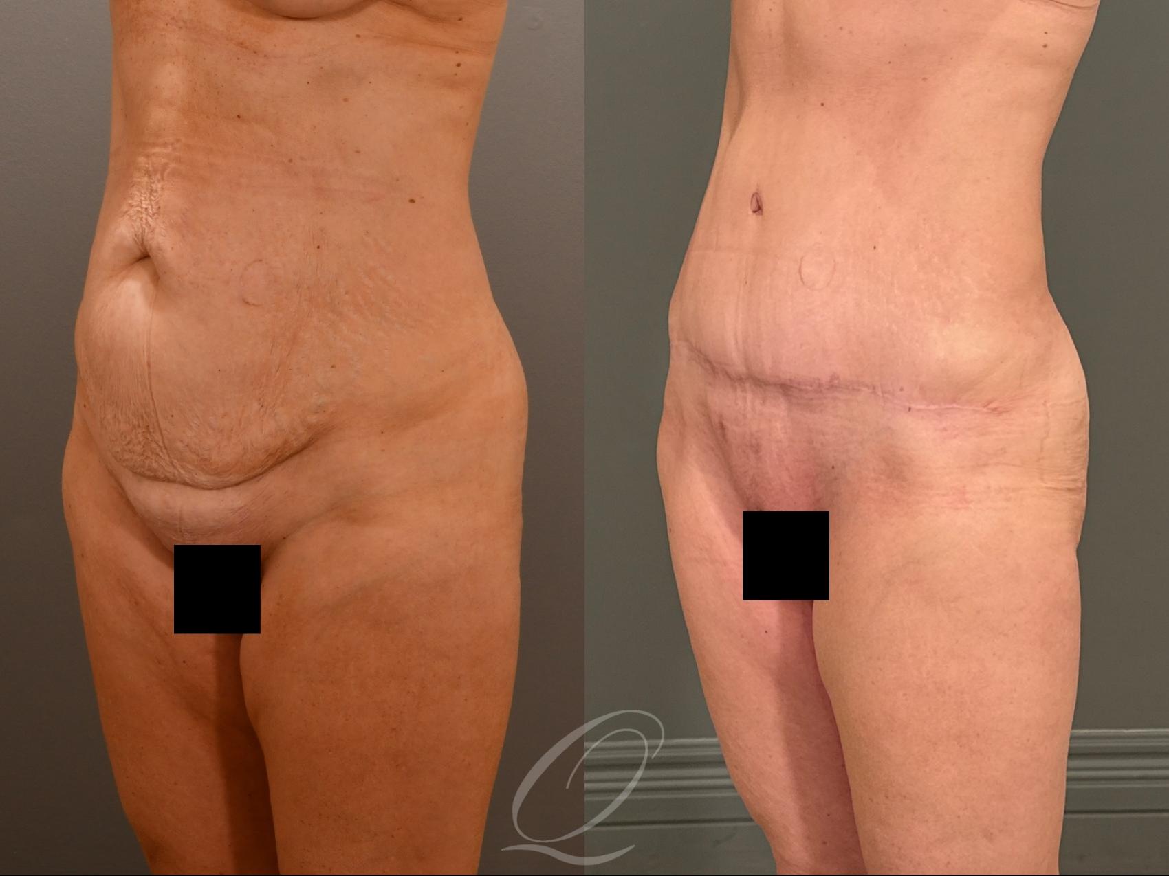 Tummy Tuck Case 1001908 Before & After Left Oblique | Serving Rochester, Syracuse & Buffalo, NY | Quatela Center for Plastic Surgery