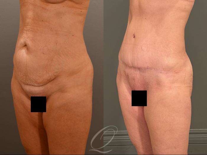 Tummy Tuck Case 1001908 Before & After Left Oblique | Serving Rochester, Syracuse & Buffalo, NY | Quatela Center for Plastic Surgery