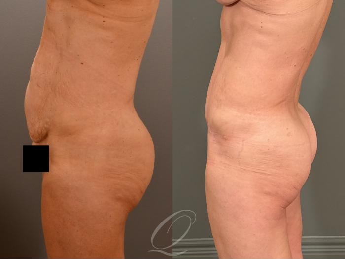 Tummy Tuck Case 1001908 Before & After Left Side | Serving Rochester, Syracuse & Buffalo, NY | Quatela Center for Plastic Surgery