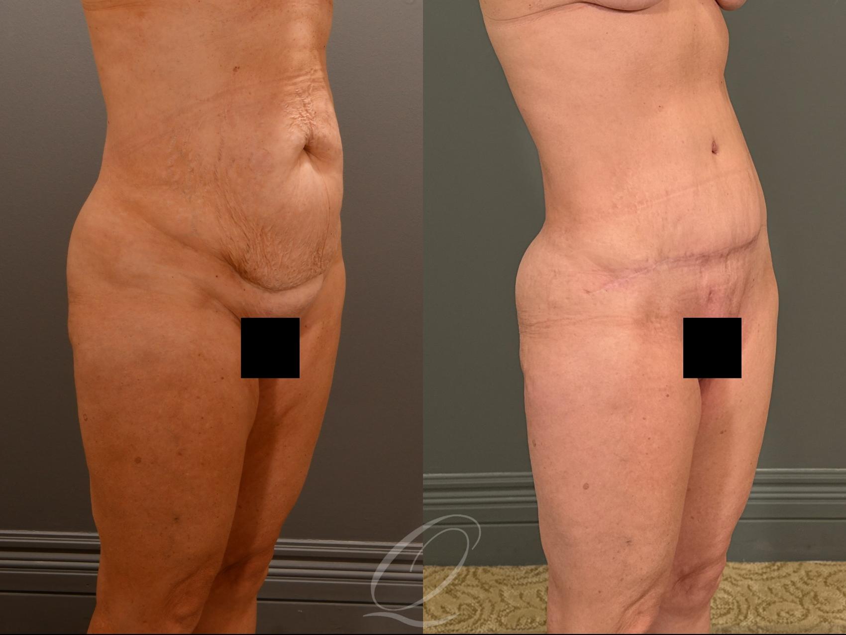 Tummy Tuck Case 1001908 Before & After Right Oblique | Serving Rochester, Syracuse & Buffalo, NY | Quatela Center for Plastic Surgery
