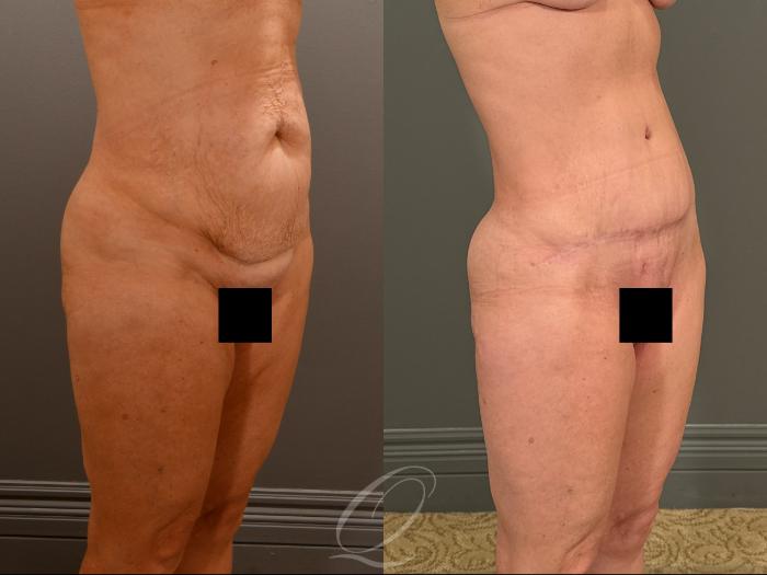 Tummy Tuck Case 1001908 Before & After Right Oblique | Serving Rochester, Syracuse & Buffalo, NY | Quatela Center for Plastic Surgery