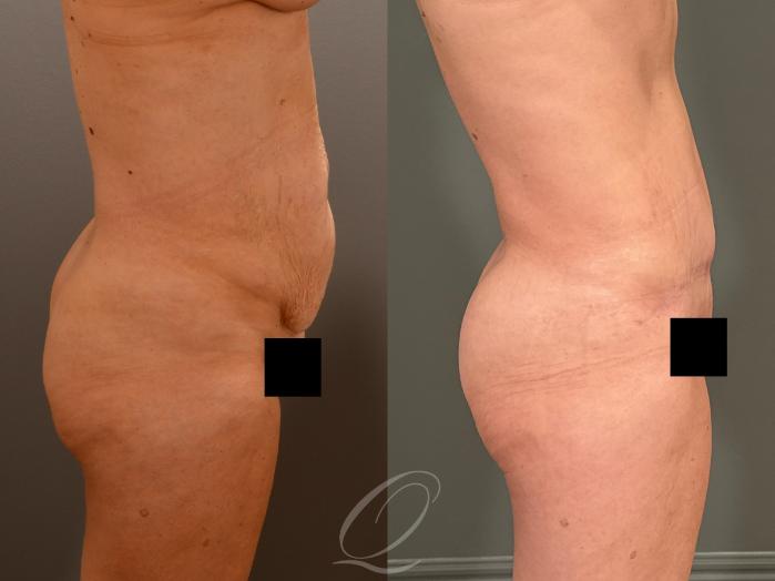 Tummy Tuck Case 1001908 Before & After Right Side | Serving Rochester, Syracuse & Buffalo, NY | Quatela Center for Plastic Surgery