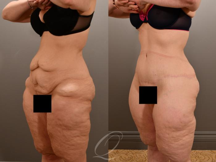 Tummy Tuck Case 1001909 Before & After Left Oblique | Serving Rochester, Syracuse & Buffalo, NY | Quatela Center for Plastic Surgery