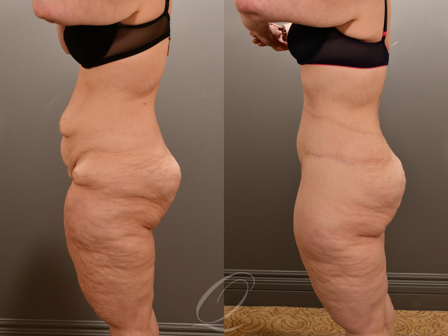 Tummy Tuck Case 1001909 Before & After Left Side | Serving Rochester, Syracuse & Buffalo, NY | Quatela Center for Plastic Surgery