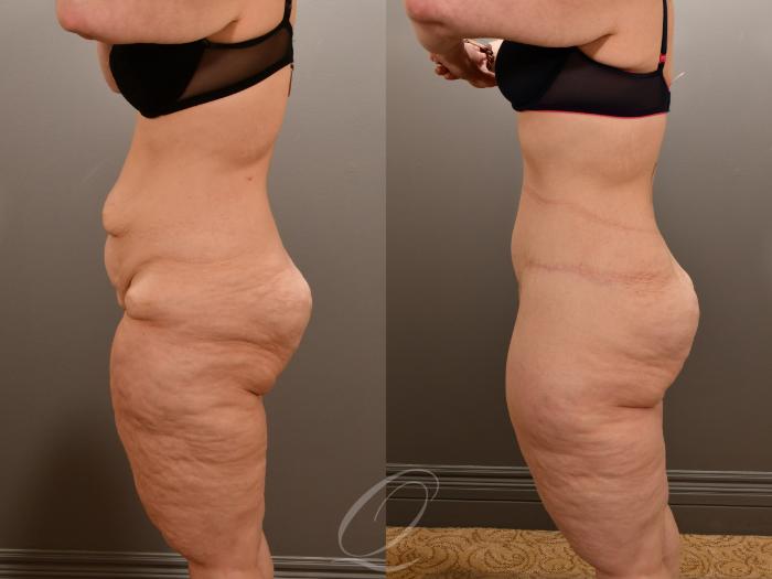 Tummy Tuck Case 1001909 Before & After Left Side | Serving Rochester, Syracuse & Buffalo, NY | Quatela Center for Plastic Surgery
