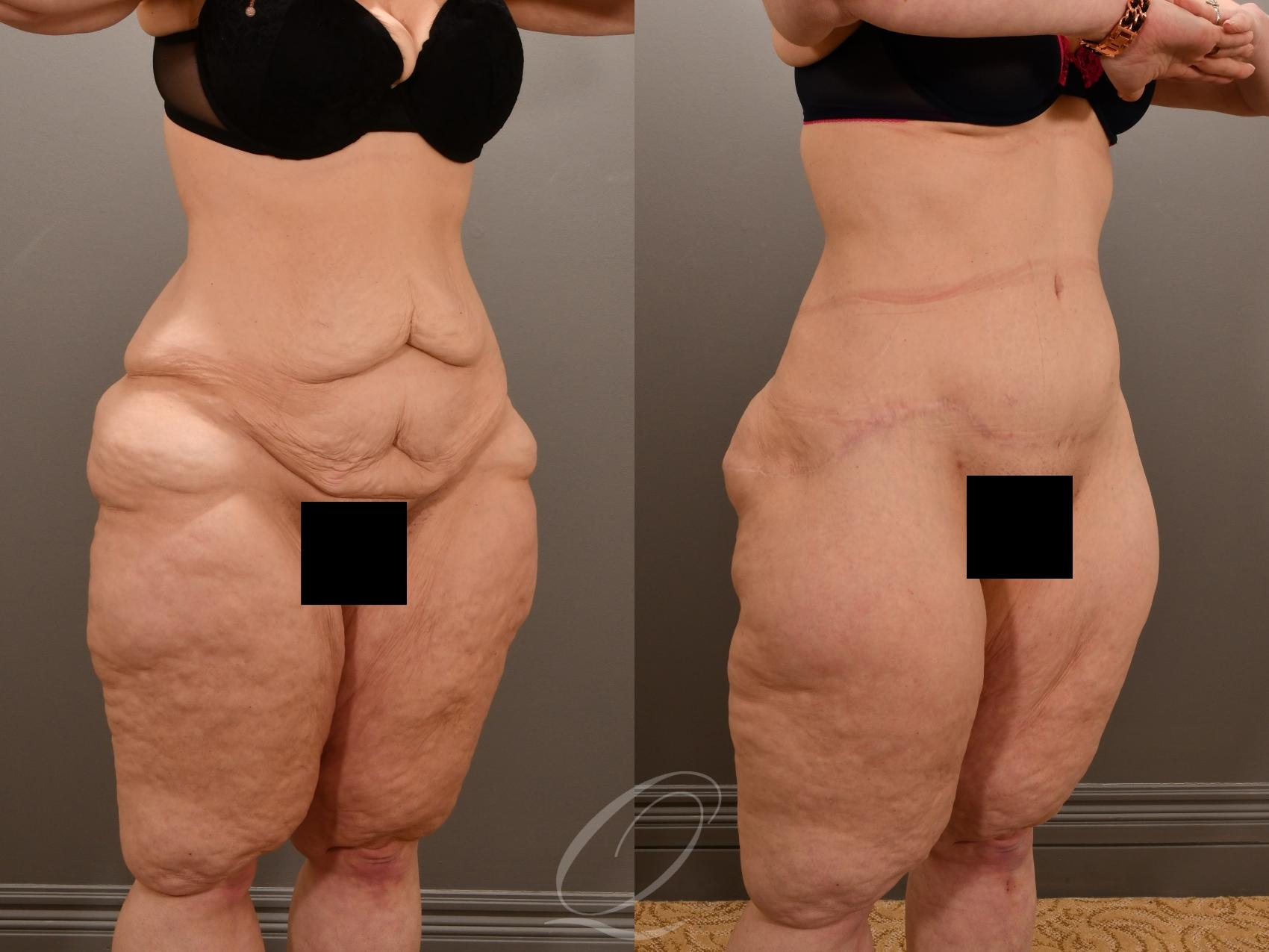 Tummy Tuck Case 1001909 Before & After Right Oblique | Serving Rochester, Syracuse & Buffalo, NY | Quatela Center for Plastic Surgery