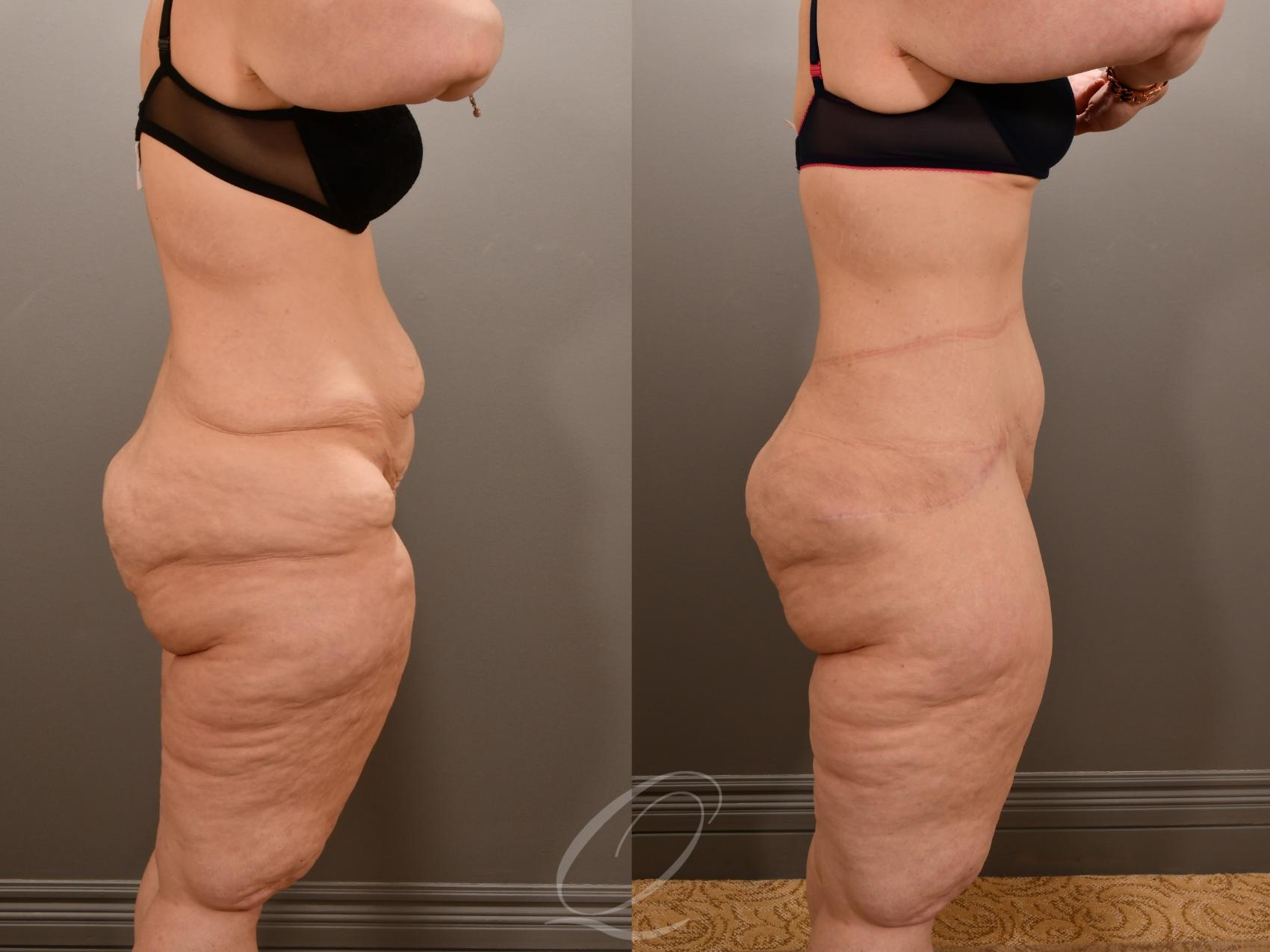 Tummy Tuck Case 1001909 Before & After Right Side | Serving Rochester, Syracuse & Buffalo, NY | Quatela Center for Plastic Surgery