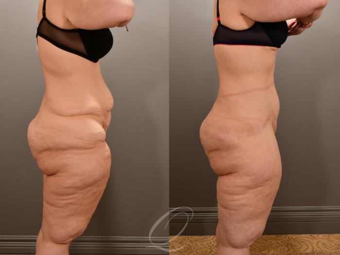 Tummy Tuck Case 1001909 Before & After Right Side | Serving Rochester, Syracuse & Buffalo, NY | Quatela Center for Plastic Surgery