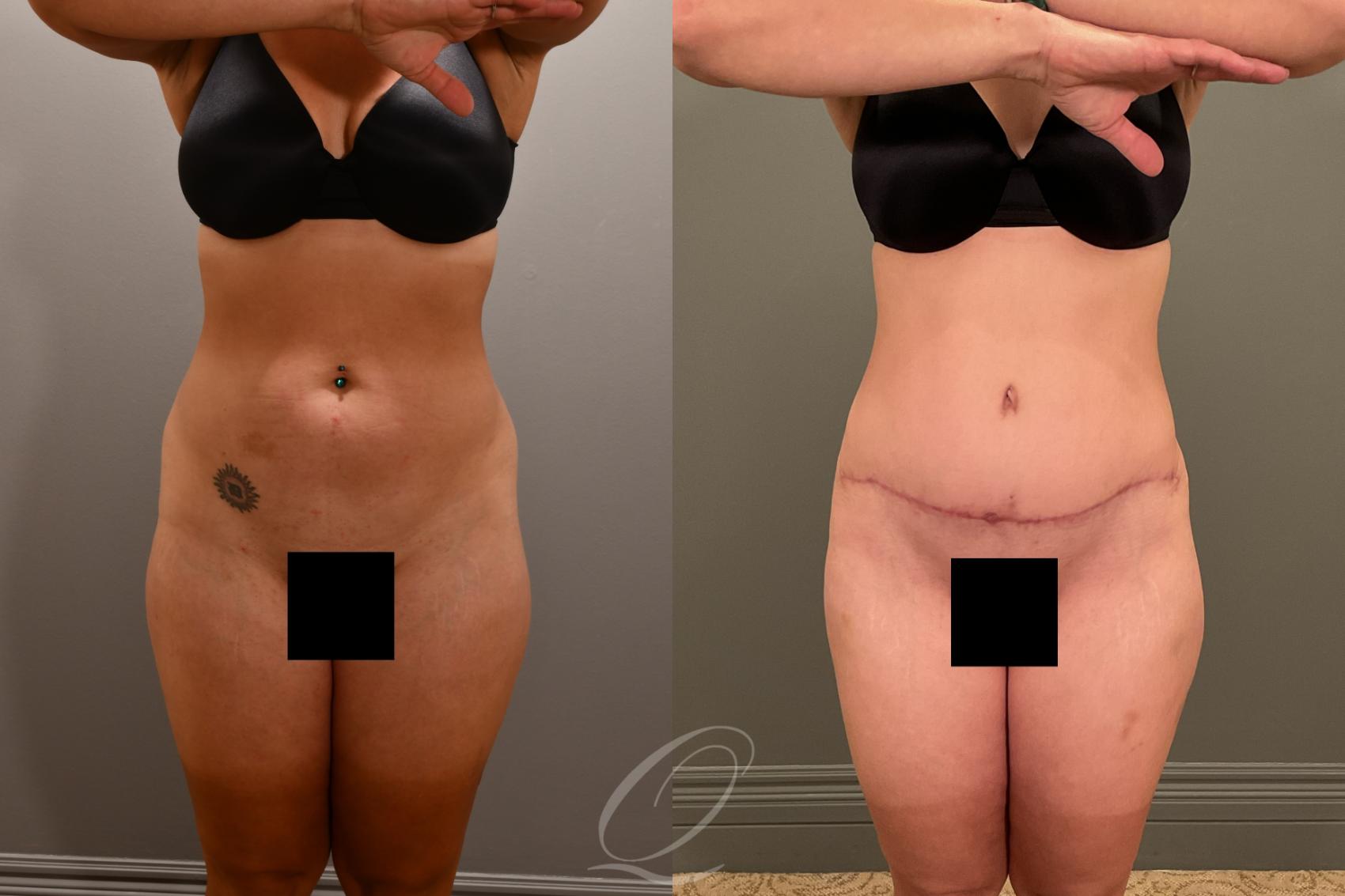 Liposuction Case 1001912 Before & After Front | Serving Rochester, Syracuse & Buffalo, NY | Quatela Center for Plastic Surgery