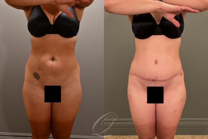 Liposuction Case 1001912 Before & After Front | Serving Rochester, Syracuse & Buffalo, NY | Quatela Center for Plastic Surgery