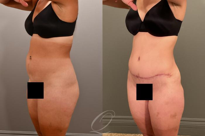 Liposuction Case 1001912 Before & After Left Oblique | Serving Rochester, Syracuse & Buffalo, NY | Quatela Center for Plastic Surgery
