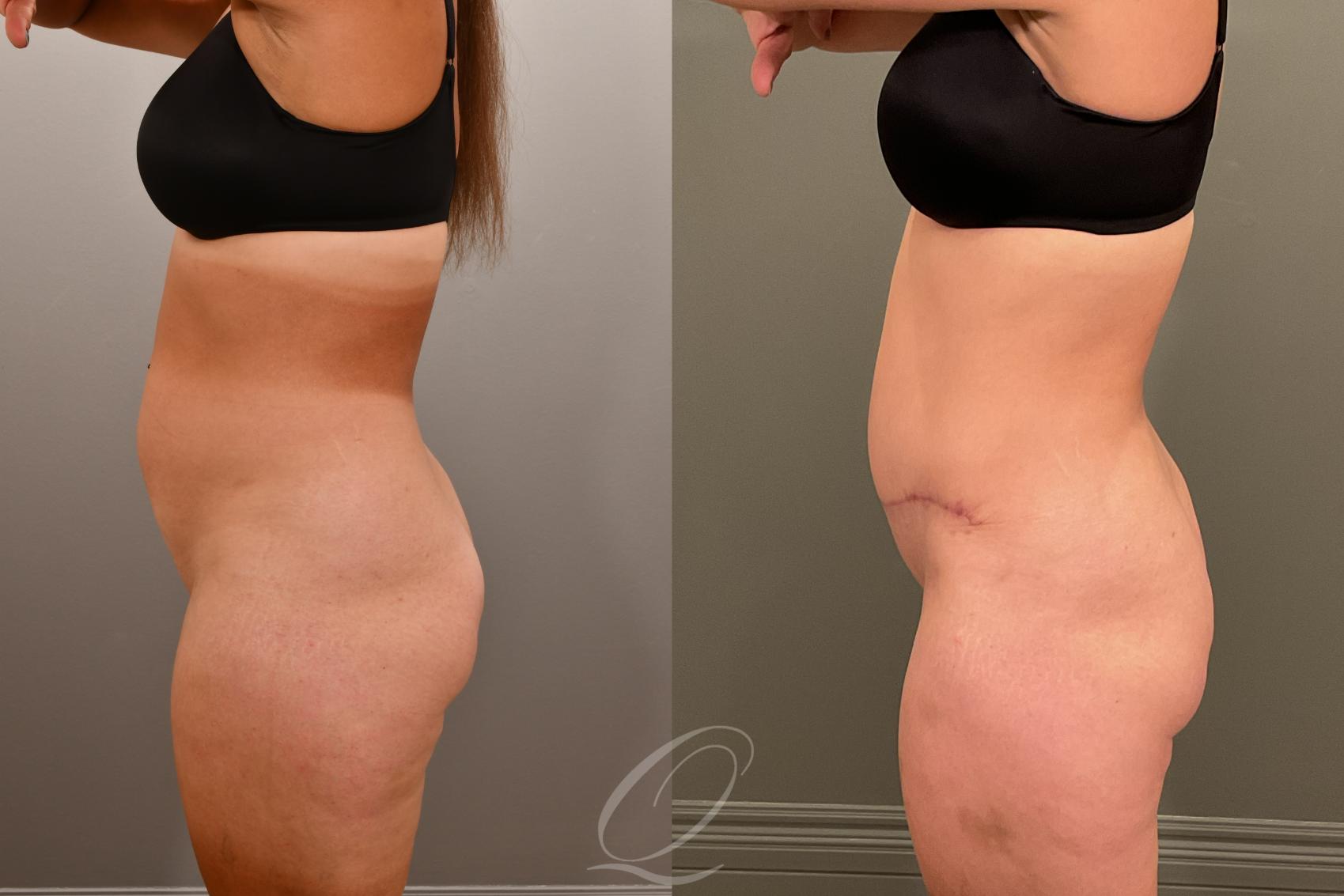 Liposuction Case 1001912 Before & After Left Side | Serving Rochester, Syracuse & Buffalo, NY | Quatela Center for Plastic Surgery