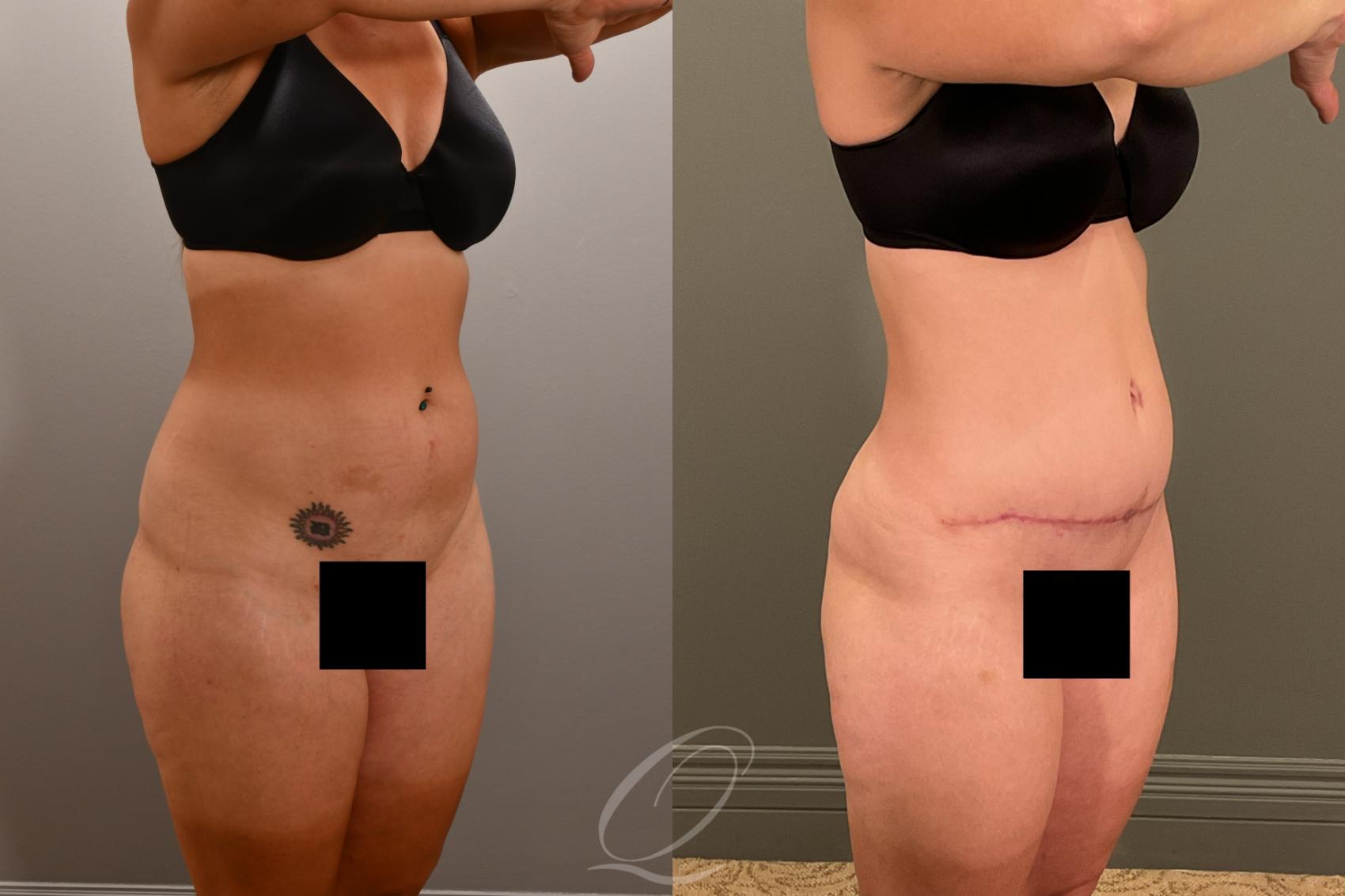 Liposuction Case 1001912 Before & After Right Oblique | Serving Rochester, Syracuse & Buffalo, NY | Quatela Center for Plastic Surgery