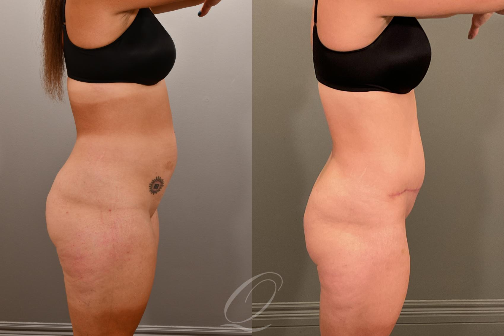 Liposuction Case 1001912 Before & After Right Side | Serving Rochester, Syracuse & Buffalo, NY | Quatela Center for Plastic Surgery