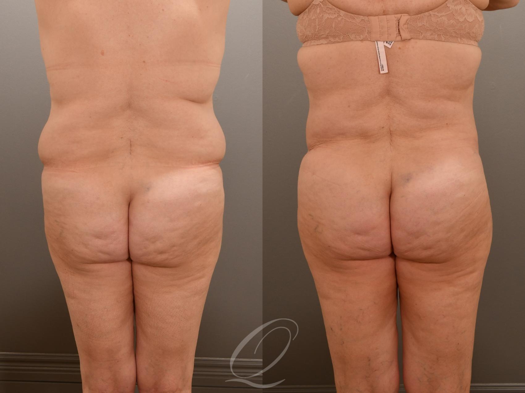 Tummy Tuck Case 1001917 Before & After Back | Serving Rochester, Syracuse & Buffalo, NY | Quatela Center for Plastic Surgery