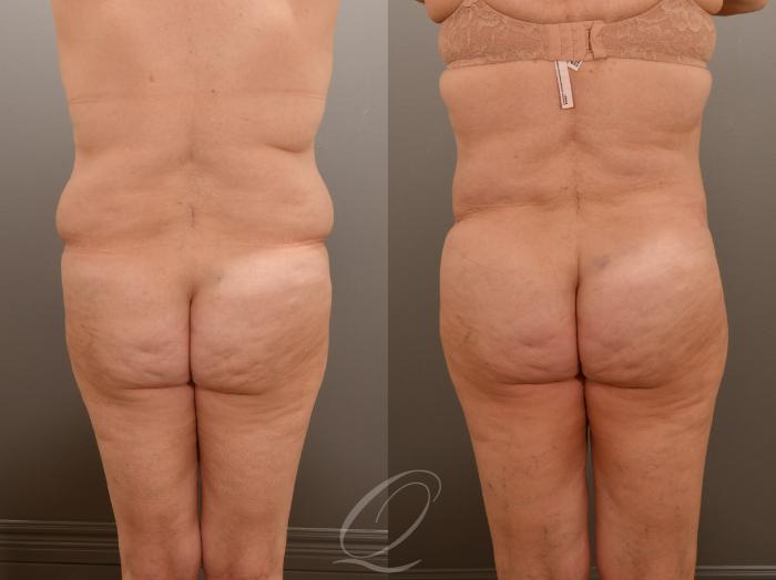 Tummy Tuck Case 1001917 Before & After Back | Serving Rochester, Syracuse & Buffalo, NY | Quatela Center for Plastic Surgery