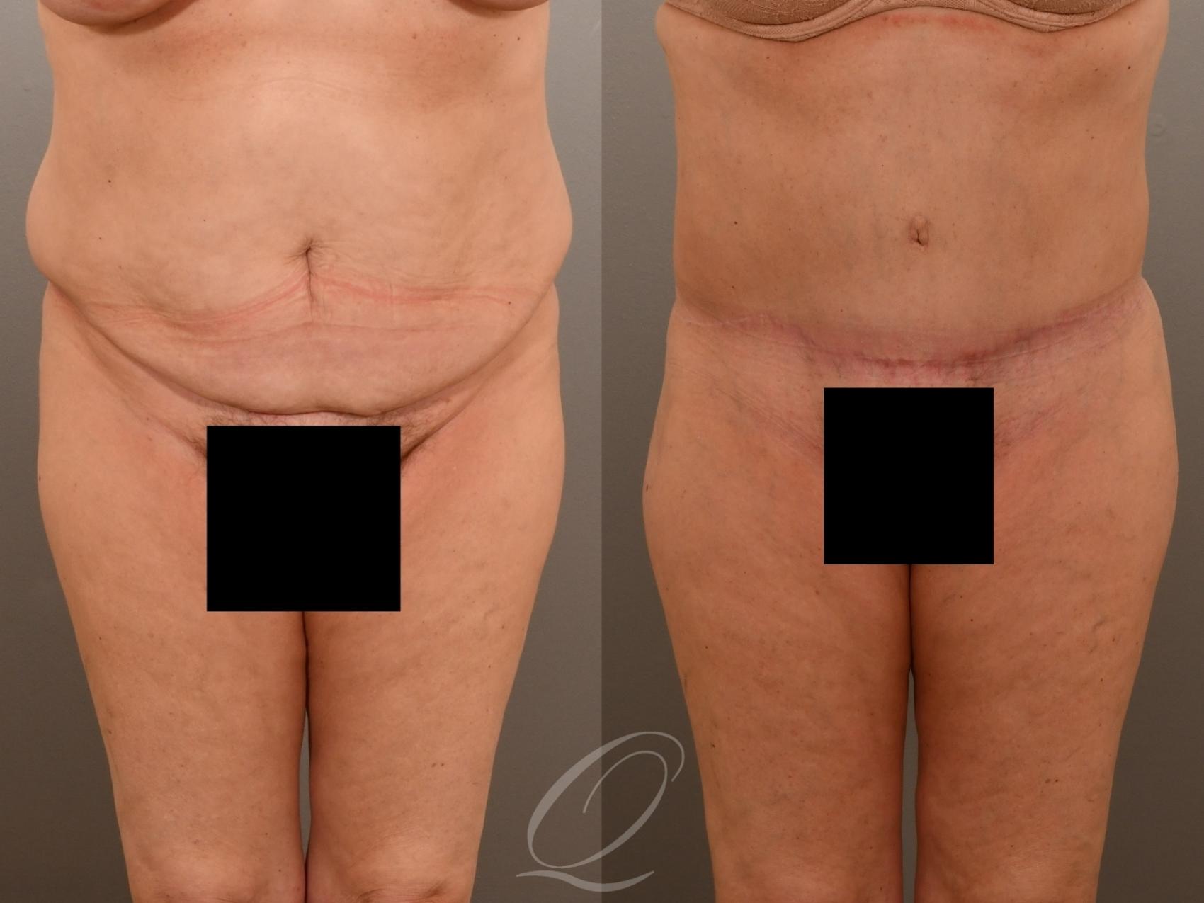 Tummy Tuck Case 1001917 Before & After Front | Serving Rochester, Syracuse & Buffalo, NY | Quatela Center for Plastic Surgery