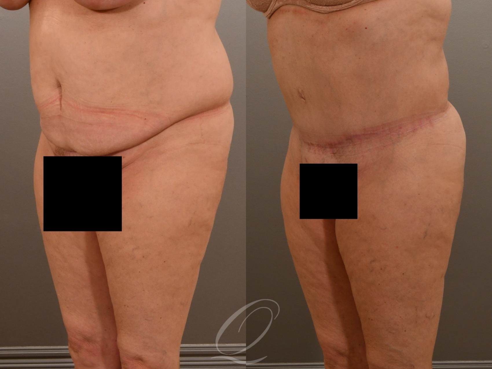 Tummy Tuck Case 1001917 Before & After Left Oblique | Serving Rochester, Syracuse & Buffalo, NY | Quatela Center for Plastic Surgery