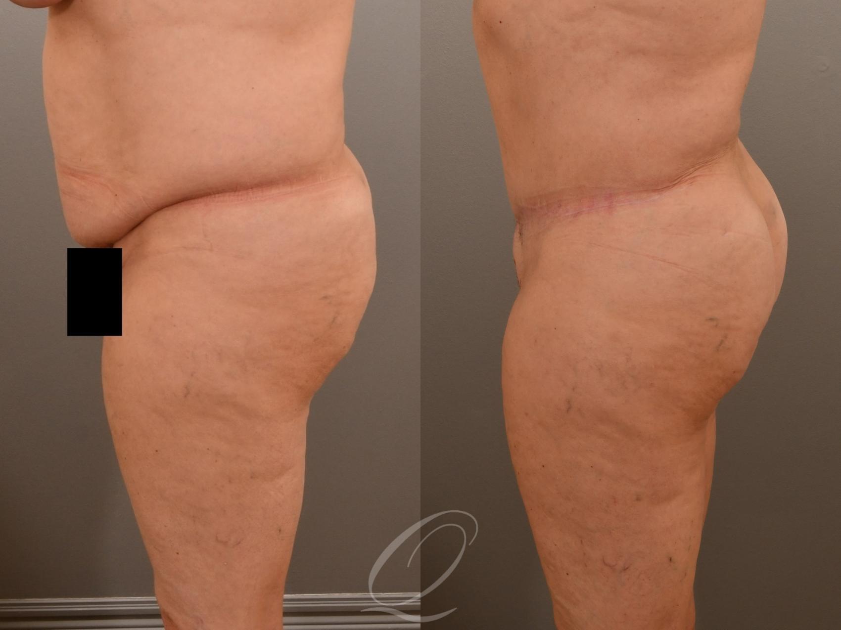 Tummy Tuck Case 1001917 Before & After Left Side | Serving Rochester, Syracuse & Buffalo, NY | Quatela Center for Plastic Surgery