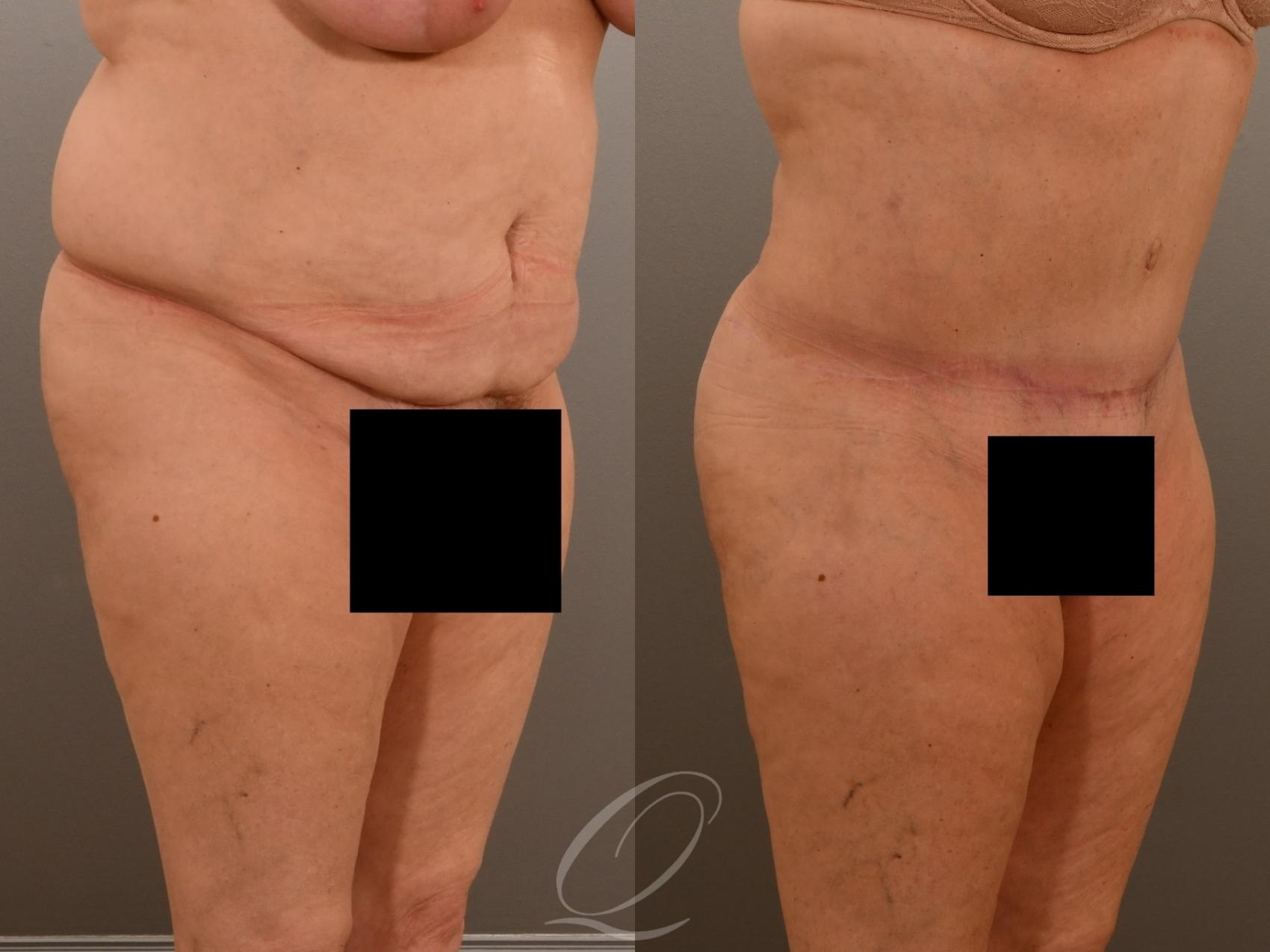 Tummy Tuck Case 1001917 Before & After Right Oblique | Serving Rochester, Syracuse & Buffalo, NY | Quatela Center for Plastic Surgery
