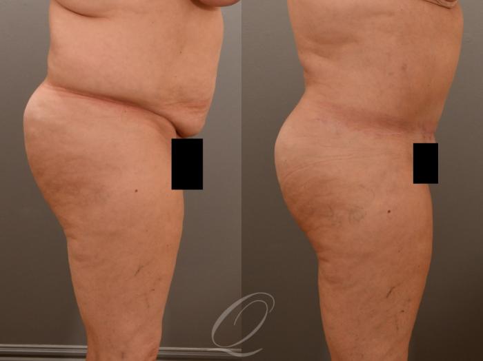 Tummy Tuck Case 1001917 Before & After Right Side | Serving Rochester, Syracuse & Buffalo, NY | Quatela Center for Plastic Surgery