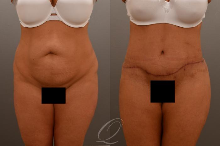 Tummy Tuck Case 1001921 Before & After Front | Serving Rochester, Syracuse & Buffalo, NY | Quatela Center for Plastic Surgery