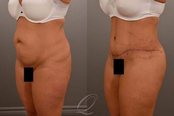 Tummy Tuck Case 1001921 Before & After Left Oblique | Serving Rochester, Syracuse & Buffalo, NY | Quatela Center for Plastic Surgery