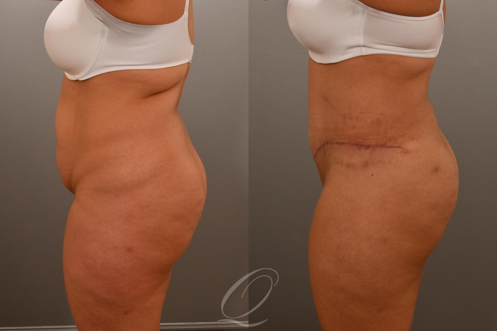 Tummy Tuck Case 1001921 Before & After Left Side | Serving Rochester, Syracuse & Buffalo, NY | Quatela Center for Plastic Surgery