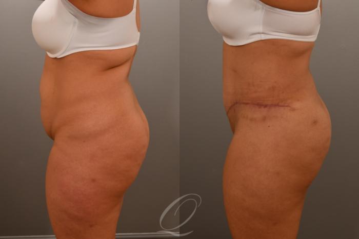 Tummy Tuck Case 1001921 Before & After Left Side | Serving Rochester, Syracuse & Buffalo, NY | Quatela Center for Plastic Surgery