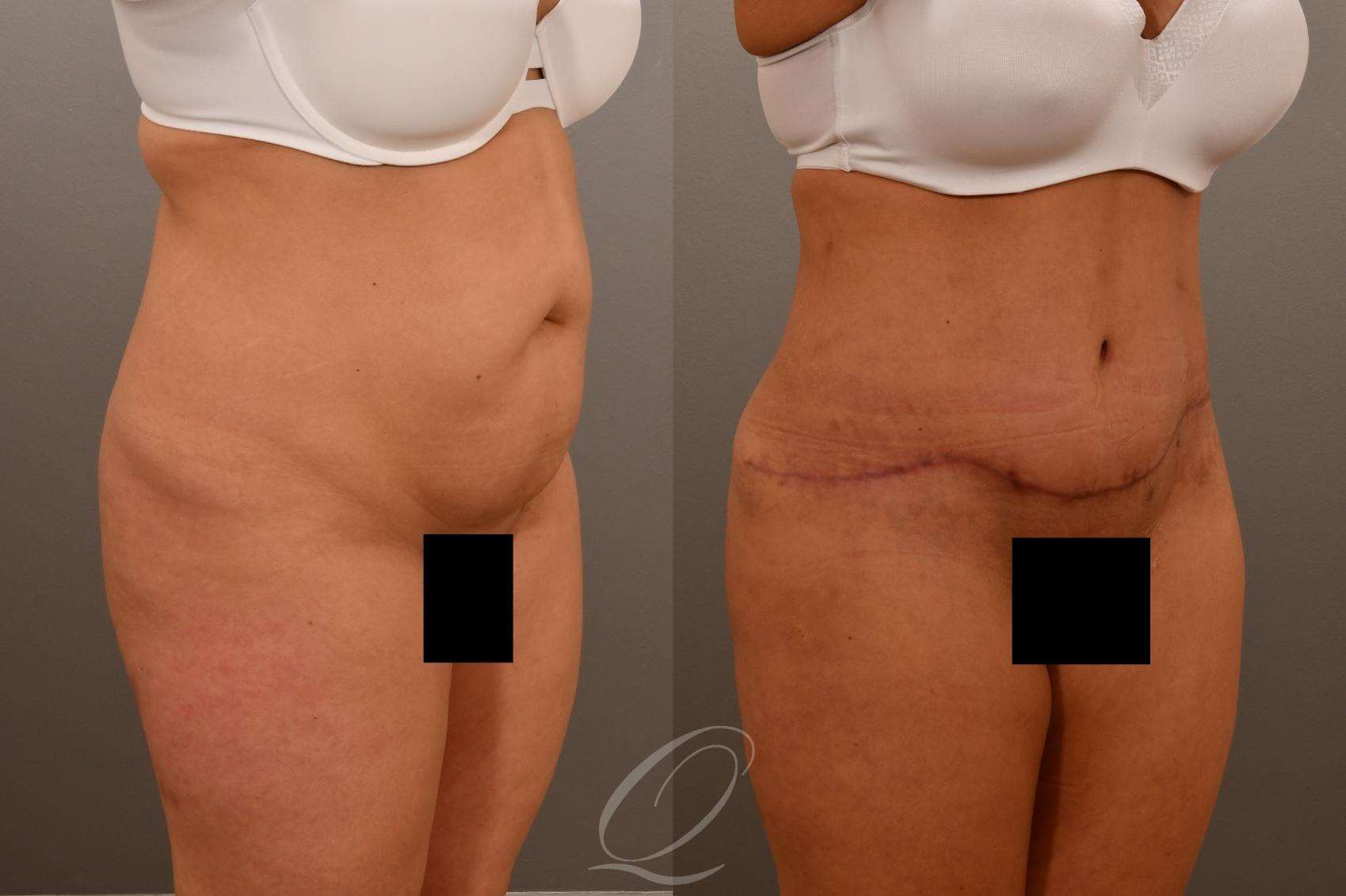 Tummy Tuck Case 1001921 Before & After Right Oblique | Serving Rochester, Syracuse & Buffalo, NY | Quatela Center for Plastic Surgery