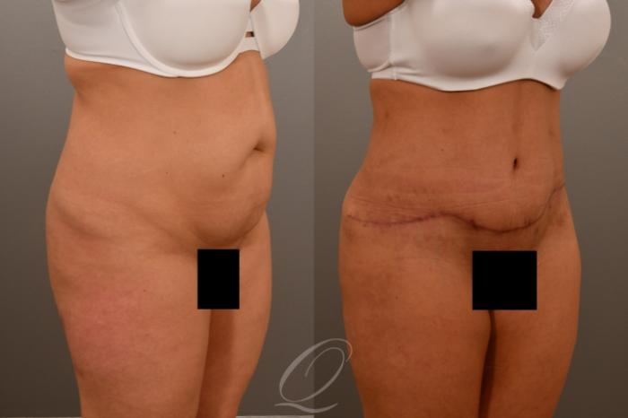 Tummy Tuck Case 1001921 Before & After Right Oblique | Serving Rochester, Syracuse & Buffalo, NY | Quatela Center for Plastic Surgery