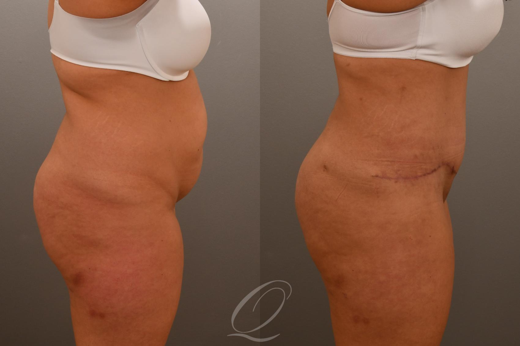 Tummy Tuck Case 1001921 Before & After Right Side | Serving Rochester, Syracuse & Buffalo, NY | Quatela Center for Plastic Surgery