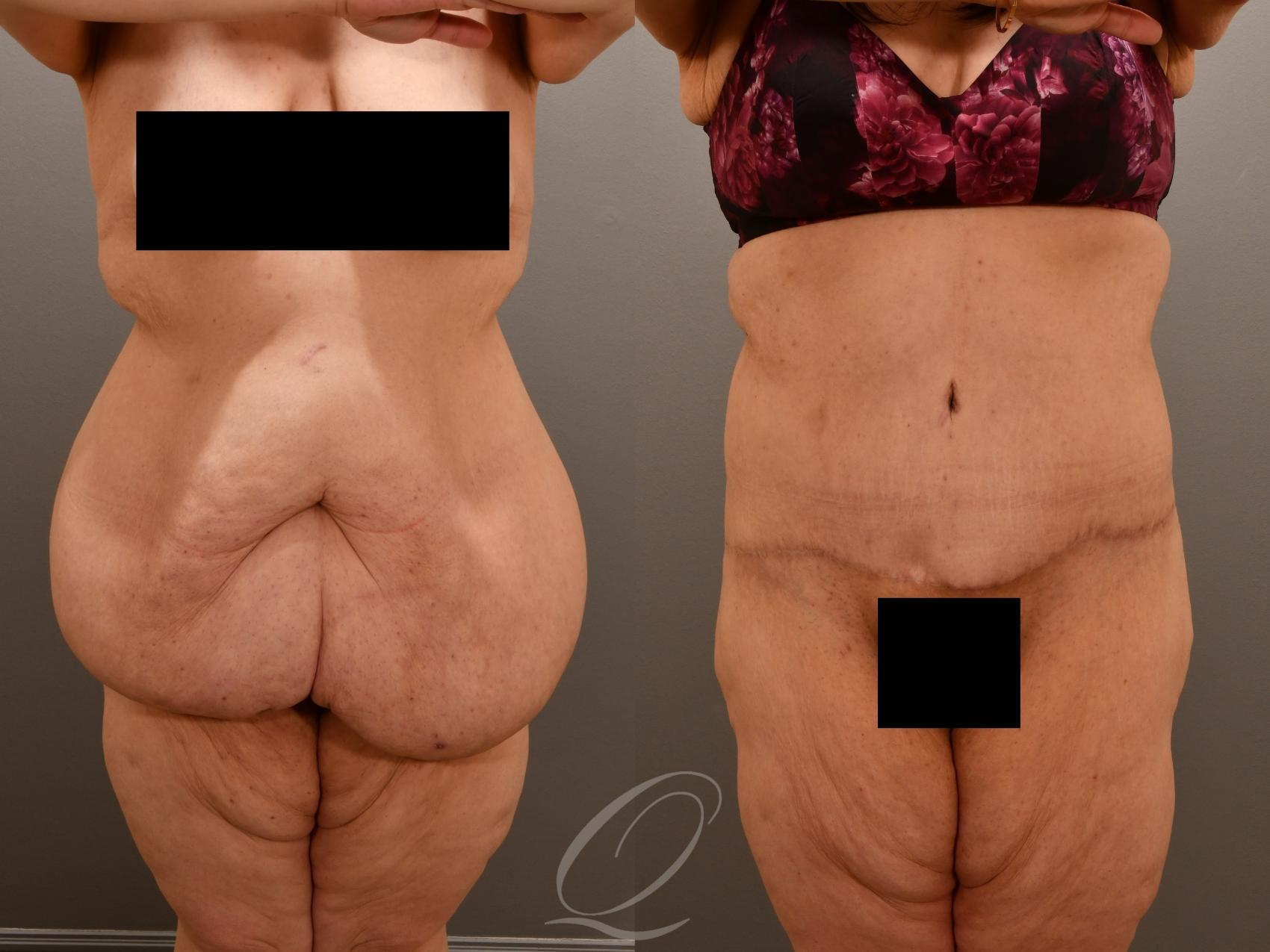 Tummy Tuck Case 1001922 Before & After Front | Serving Rochester, Syracuse & Buffalo, NY | Quatela Center for Plastic Surgery
