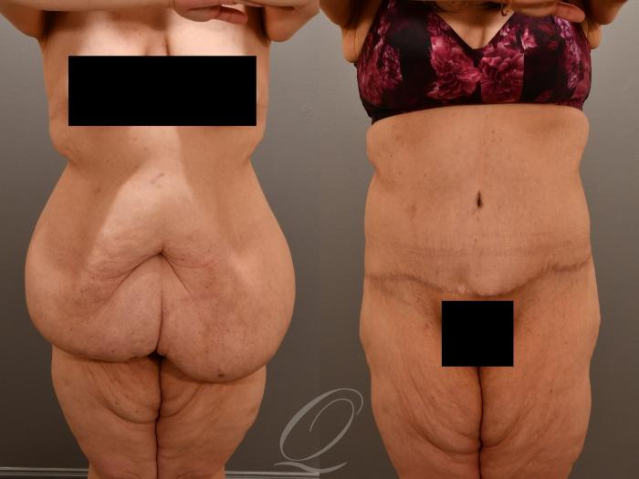Tummy Tuck Case 1001922 Before & After Front | Serving Rochester, Syracuse & Buffalo, NY | Quatela Center for Plastic Surgery