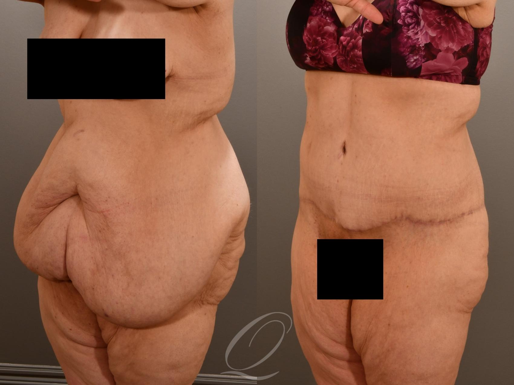 Tummy Tuck Case 1001922 Before & After Left Oblique | Serving Rochester, Syracuse & Buffalo, NY | Quatela Center for Plastic Surgery