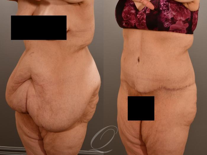 Tummy Tuck Case 1001922 Before & After Left Oblique | Serving Rochester, Syracuse & Buffalo, NY | Quatela Center for Plastic Surgery