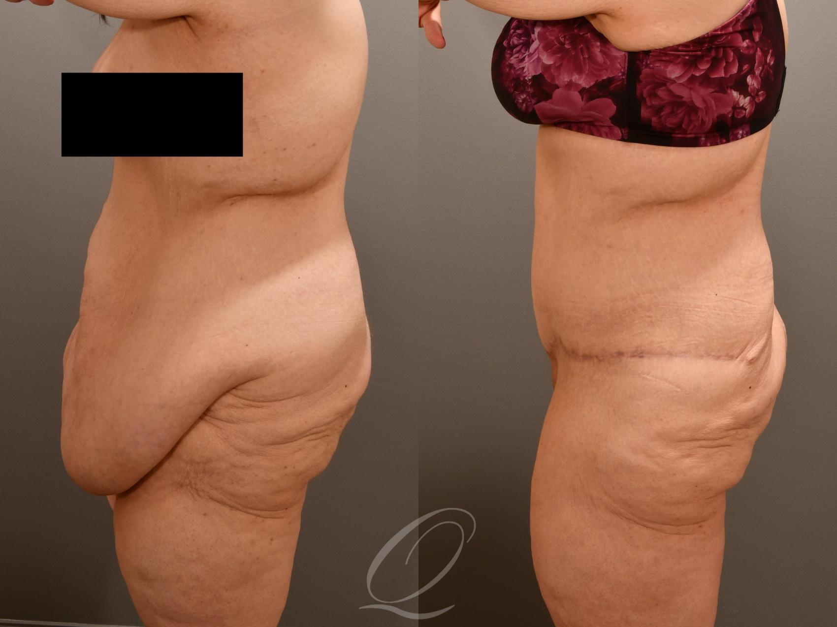 Tummy Tuck Case 1001922 Before & After Left Side | Serving Rochester, Syracuse & Buffalo, NY | Quatela Center for Plastic Surgery