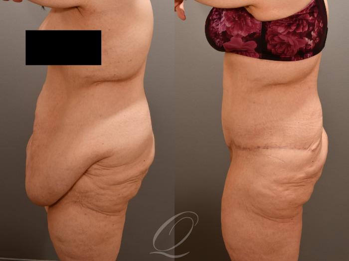 Tummy Tuck Case 1001922 Before & After Left Side | Serving Rochester, Syracuse & Buffalo, NY | Quatela Center for Plastic Surgery