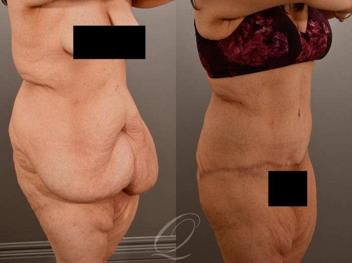 Tummy Tuck Case 1001922 Before & After Right Oblique | Serving Rochester, Syracuse & Buffalo, NY | Quatela Center for Plastic Surgery
