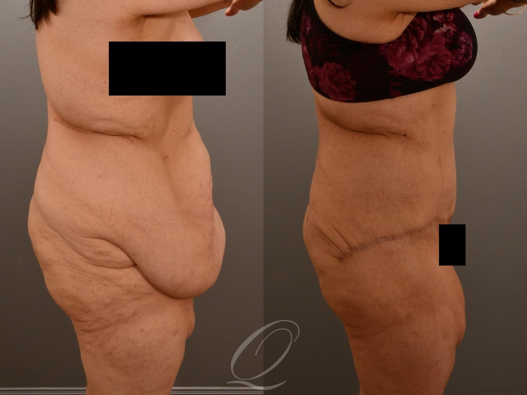 Tummy Tuck Case 1001922 Before & After Right Side | Serving Rochester, Syracuse & Buffalo, NY | Quatela Center for Plastic Surgery