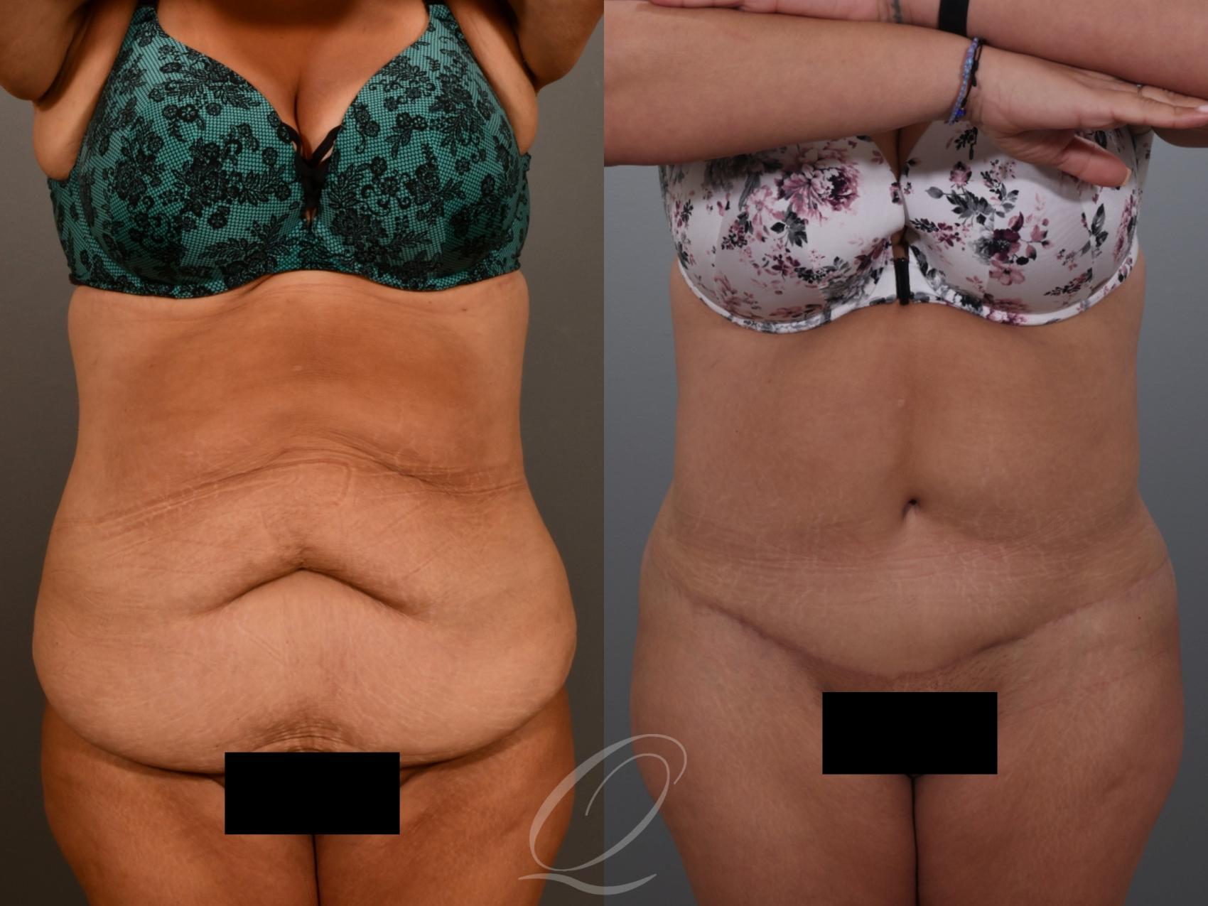 Tummy Tuck Case 1001934 Before & After Front | Serving Rochester, Syracuse & Buffalo, NY | Quatela Center for Plastic Surgery