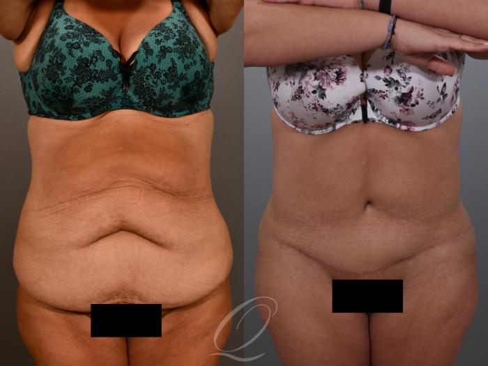 Tummy Tuck Case 1001934 Before & After Front | Serving Rochester, Syracuse & Buffalo, NY | Quatela Center for Plastic Surgery