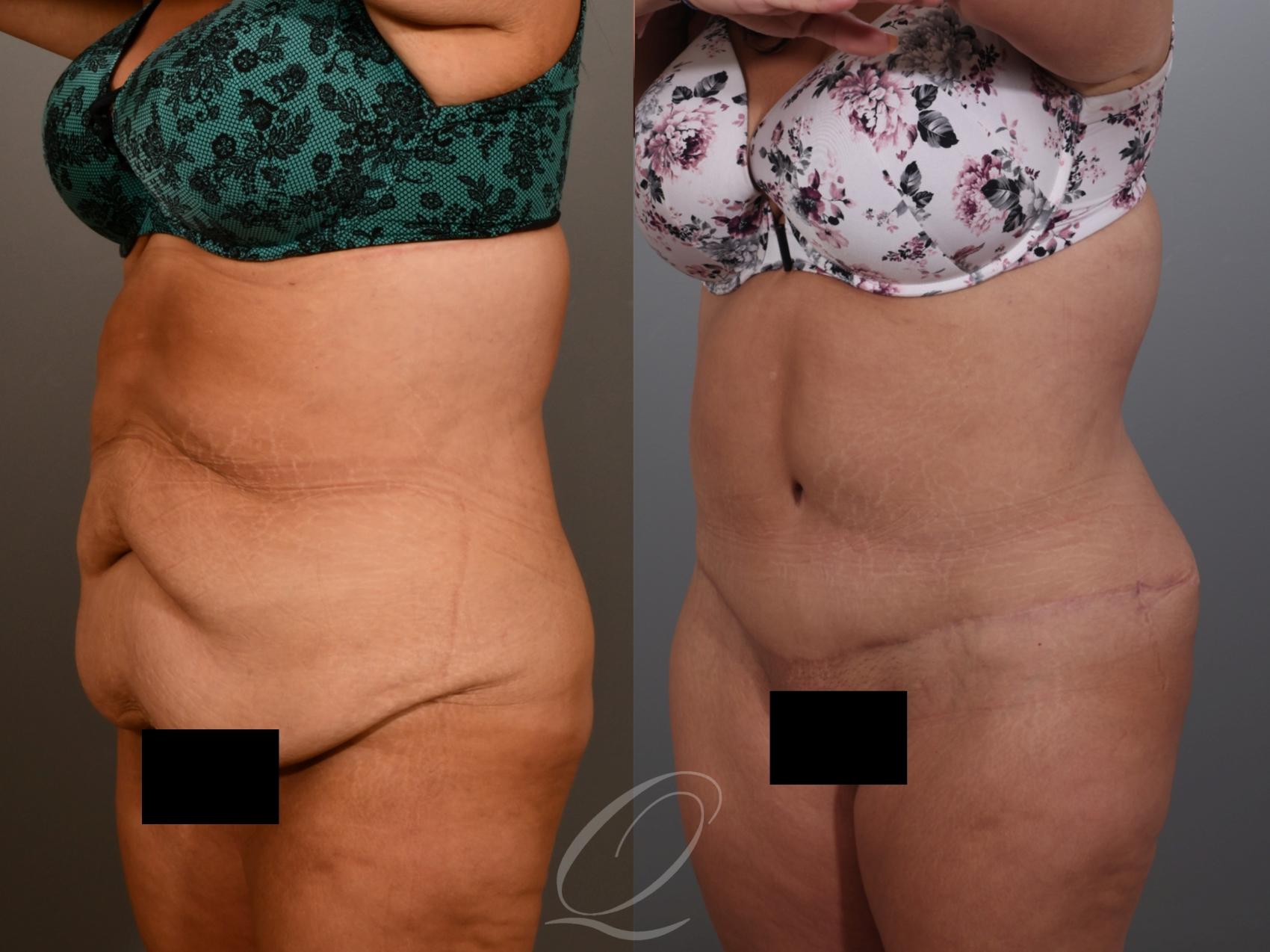 Tummy Tuck Case 1001934 Before & After Left Oblique | Serving Rochester, Syracuse & Buffalo, NY | Quatela Center for Plastic Surgery