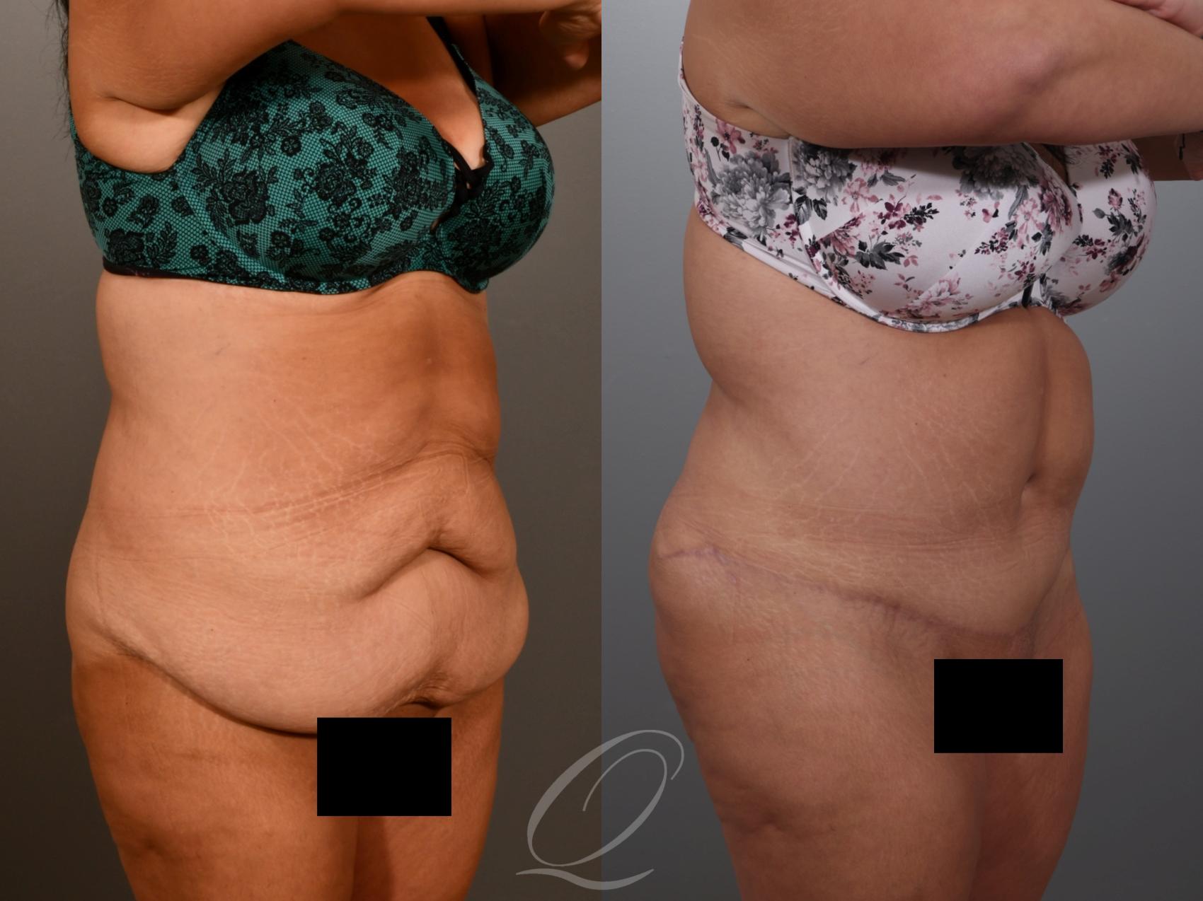 Tummy Tuck Case 1001934 Before & After Right Oblique | Serving Rochester, Syracuse & Buffalo, NY | Quatela Center for Plastic Surgery