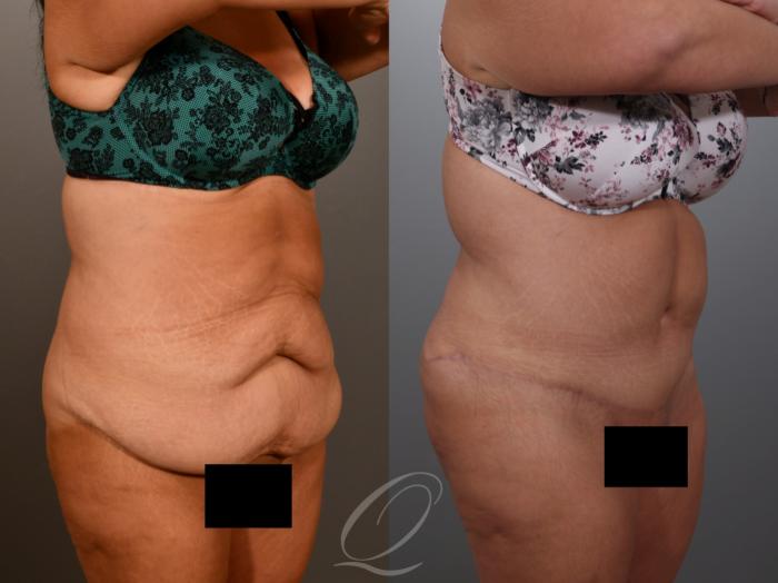 Tummy Tuck Case 1001934 Before & After Right Oblique | Serving Rochester, Syracuse & Buffalo, NY | Quatela Center for Plastic Surgery