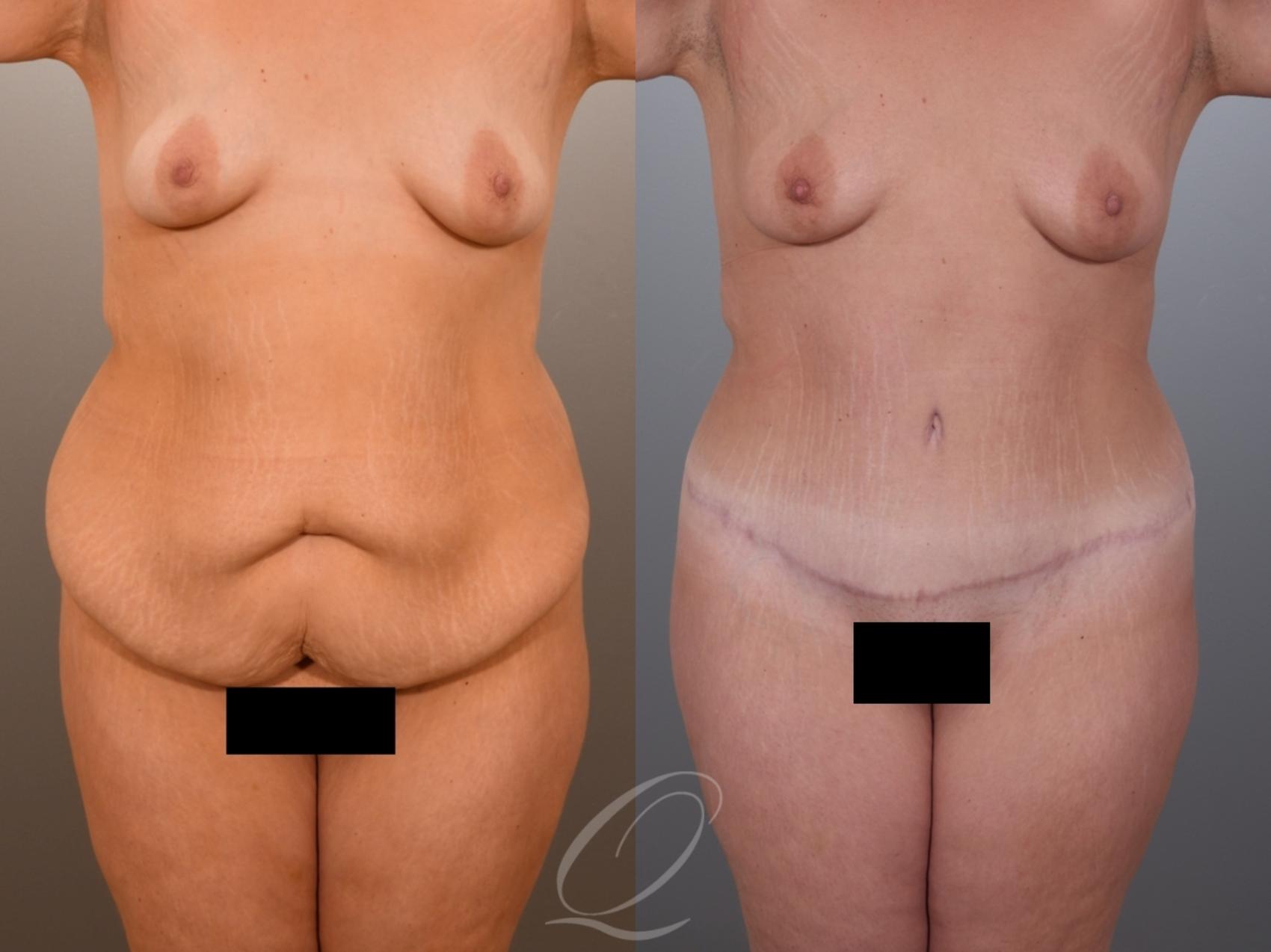 Tummy Tuck Case 1001969 Before & After Front | Serving Rochester, Syracuse & Buffalo, NY | Quatela Center for Plastic Surgery