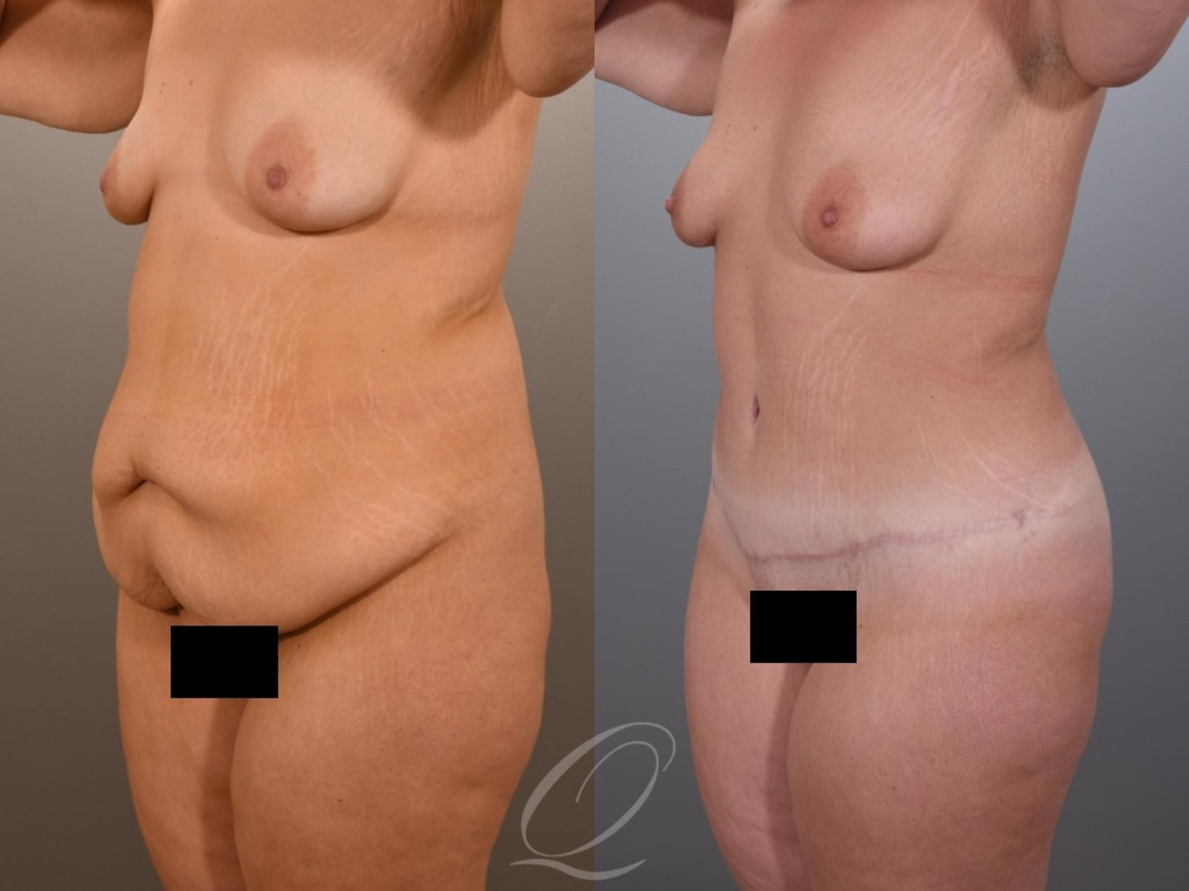 Tummy Tuck Case 1001969 Before & After Left Oblique | Serving Rochester, Syracuse & Buffalo, NY | Quatela Center for Plastic Surgery