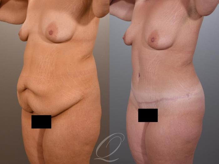 Tummy Tuck Case 1001969 Before & After Left Oblique | Serving Rochester, Syracuse & Buffalo, NY | Quatela Center for Plastic Surgery