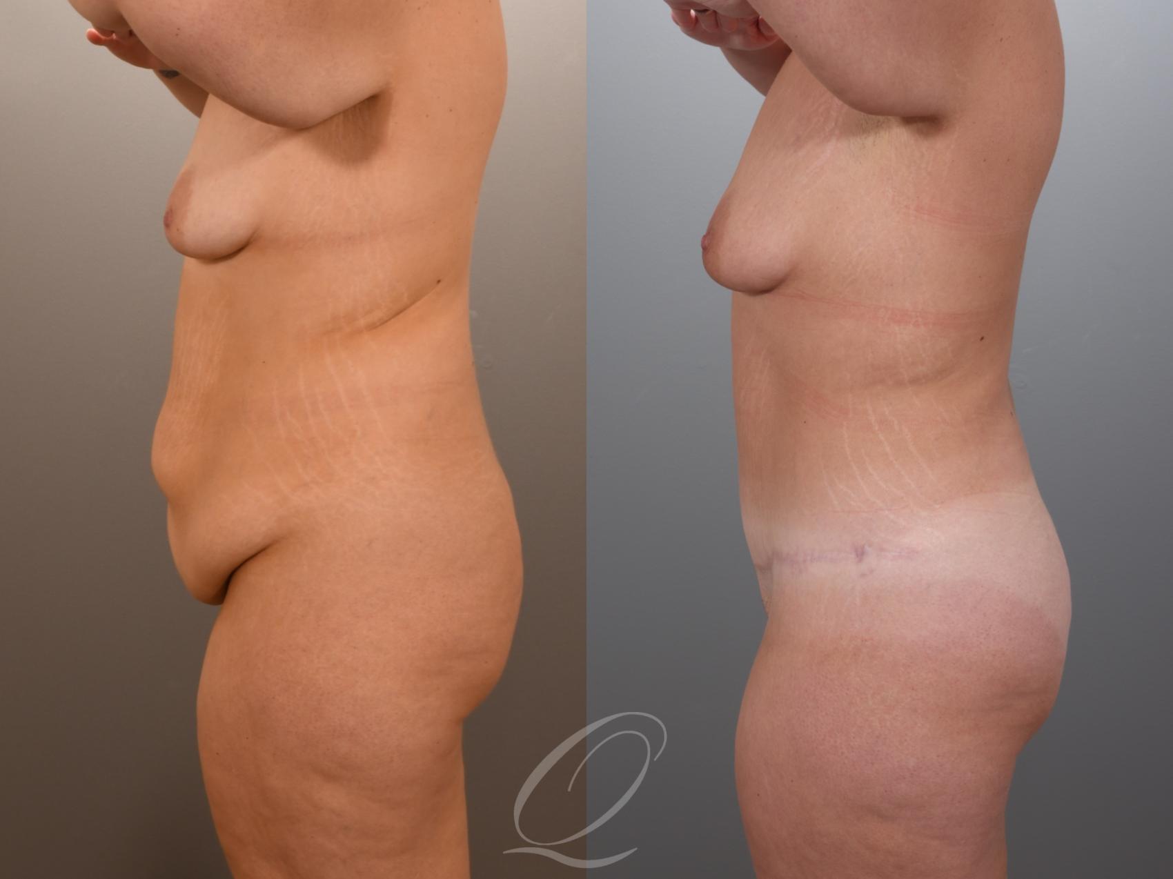 Tummy Tuck Case 1001969 Before & After Left Side | Serving Rochester, Syracuse & Buffalo, NY | Quatela Center for Plastic Surgery